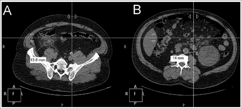 Figure 1. Abdominal CT-scan findings in Erdheim-Chester disease. (A) - Appearance of acute uncomplicated appendicitis with a marked inflammatory thickening of the whole appendix (up to 14 mm; dotted line and perpendicular measuring bar), in the usual anatomical localization, without stercolithis. Significant infiltration of adjacent mesenteric fat, without collection, is noted. (B) - Left pararenal lymphadenopathy (12–13 mm; dotted line and perpendicular measuring bar). Atrophied right kidney (not shown) and hypertrophic left kidney (15 × 9 × 9 cm).