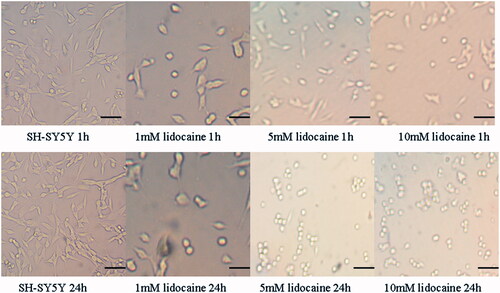 Figure 1. The morphological changes of SH-SY5Y cells treated with different concentrations and exposure time of lidocaine hydrochloride. Attached cells grown in multiwall culture plates were observed at room temperature. Images were taken using an inverted microscope. All images have the same magnification of ×100, bar = 25um.