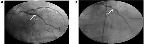 Figure 5 (A and B) Conventional coronary angiography showing a left coronary angiogram. The anteroposterior caudal and cranial views showed spontaneous dissection of the main left coronary artery extended to the mid-segment of the LAD artery with severe stenosis (95%) of the mid-segment of the LAD artery (arrows show the stenotic segment).