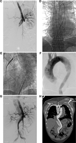 Figure 1 A 63-year-old man who presented with 3 months of chest and back pain was diagnosed with chronic TBAD with aneurysm degeneration (using patient 4 as an example). Total stent graft diameter and length were 36 mm and 200 mm, respectively. Two RBSs were implanted, and the diameter of the proximal RBS was 26 mm.