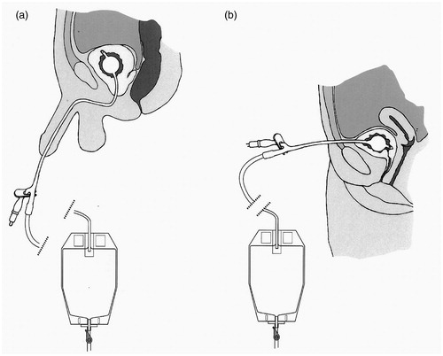 Figure 5. The Foley catheter, introduced (a) Urethrally and (b) Suprapubically. In both cases, the bladder is shown to be draining continuously into a urine collection bag attached to the leg: this bag can be emptied when necessary by opening a valve. Alternatively, the bladder can be drained intermittently if a catheter valve is inserted into the drainage funnel of the catheter.