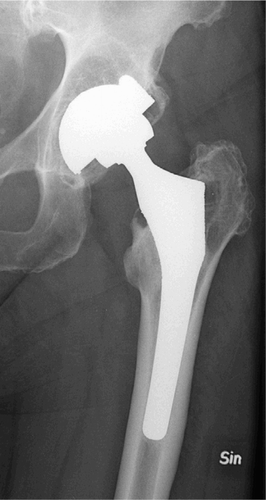 Figure 3. A hip with a 17-year-old PCA prosthesis. Very severe polyethylene wear is evident, but there is no sign of osteolysis. Stress shielding around the trochanter major area and behind the cup is quite obvious.