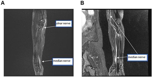 Figure 4 MRI of the left arm. (A and B) Respective images of the left arm using MRI examination.