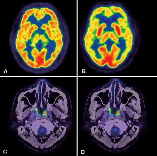 Figure 1 Cerebral 18F-FDG Metabolism of a healthy control (A) and a patient (B–D). A 53-year-old male underwent 18F-FDG PET/CT (A) during a health check, which showed relatively symmetric cerebral 18F-FDG metabolism. No obvious abnormal metabolism was observed. 18F-FDG metabolism in the basal ganglia was similar to that in the cortex. A 58-year-old male was diagnosed with stage II nasal type ENKTL, and pretreatment 18F-FDG PET/CT revealed soft tissue in the left nasal cavity (C) and swollen lymph nodes in the right neck (D) with increased 18F-FDG uptake. His pretreatment TLG was 36.9. Brain 18F-FDG PET images demonstrated prominent hypometabolism in the bilateral frontal, parietal, and temporal cortices, with relative sparing of the occipital cortex. The metabolism of the bilateral basal ganglia was prominently higher than the cortex (B). The patient had been disease free for 30 months at the end of follow-up.