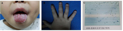 Figure 1 Patient No.1 (A) Image of oral mucosal of the patient No.1 (B) Image of right-hand fingers of the patient No.1 (C) Microscopic findings of oral mucosa from the patient No.1.
