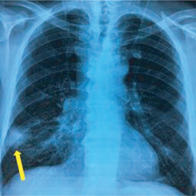 Figure 1. Chest x-ray showing a spiculated opacity in the right lung.