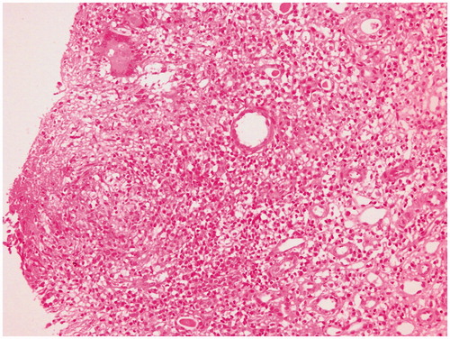 Figure 1. Renal biopsy showing interstitial epithelioid cell granuloma, Langhan’s giant cell and focal necrosis along with atrophic tubules (Hematoxylin and eosin, ×200).