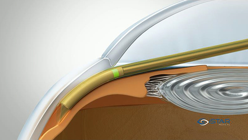 Figure 5 Image showing the delivery sheath being advanced within the suprachoroidal space until the middle of the green coloured ring on the implant is aligned with the scleral spur. © iSTAR Medical.