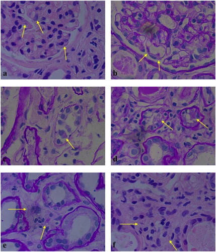 Figure 2. Crystalline inclusions in podocytes (a: HE; b: PAS), proximal tubular epithelial cells (c, d: PAS) and histiocytes (e: PAS; f: HE) (original magnification all ×1000).