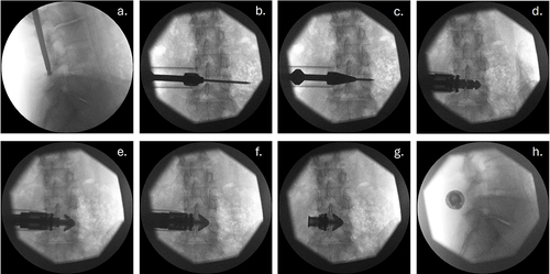 Figure 2 Intraoperative scans showing IFD implantation: (a) guidewire trajectory - lateral view, (b) and (c) decortication of the interspinous-interlaminar space and IFD sizing, (d) IFD insertion, (e) IFD wing deployment, (f) IFD fixation achieved by compression between spiked wings and plate, (g) Final IFD placement – A-P view, (h) Final IFD placement – lateral view.