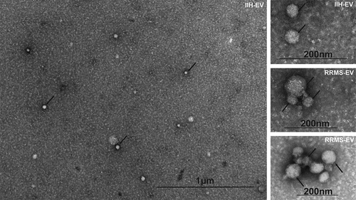 Figure 2. CSF-EV imaging by transmission electron microscopy. A proportion of both RRMS and IIH EV isolates were examined using transmission electron microscopy, as indicated (top right of each image), and representative fields are shown including a wide-field view (main image). Representatives of the heterogeneous EV populations are highlighted with black arrows and the scale indicated on each image.