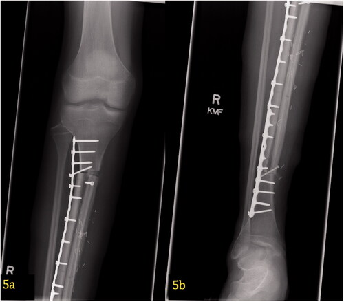 Figure 5. (a,b) Post-operative X-ray of free microvascular fibular graft. At 29 months postoperatively, proper alignment of the hemi-tibia allograft and free microvascular fibular graft can be seen in the proximal (5a) and distal (5b) portions of the tibia. This AP image shows two plates with screws spanning the entire defect.