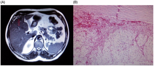 Figure 2. (A) Magnetic resonance image: a perihepatic mass lesion measuring 20 × 18 × 12 mm located on the anterior segment of the right lobe of the liver. (B) Hematoxylin and eosin stain of the peritoneal renal cell carcinoma implant (100×).