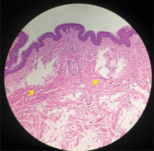 Figure 3. Histology from specimen No.3 demonstrating intra-dermal LIC (Hematoxylin and eosin (H&E), 100X).