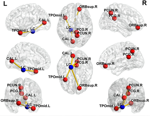 Figure 2 Visualization of brain regions with increased functional connectivity with the locus coeruleus in CID. The figure is marked as an abbreviation in the ALL. The result of the brain regions that the research obtained is Visualized with the BrainNetViewer (Xia et al, 2013, http://www.nitrc.org/projects/bnv/).