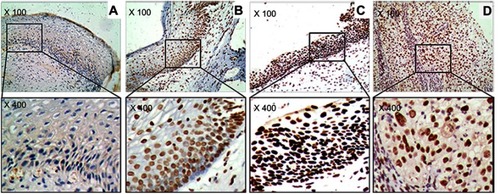 Figure 1 The marker (ATM) of DNA damage response in study sample. (A) Cervicitis; (B) CIN I; (C) CIN II/III; (D) SCC. Original magnification, ×100 and ×400.