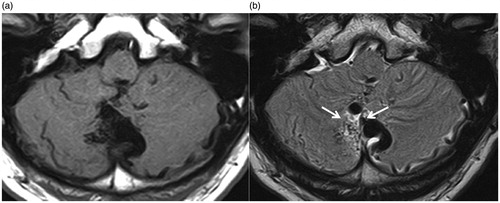 Figure 3. MRI findings. a. T1 weighted imaging. b. Flair imaging. Arrows indicate the flow void of AVM nidus located in the cerebellar vermis.
