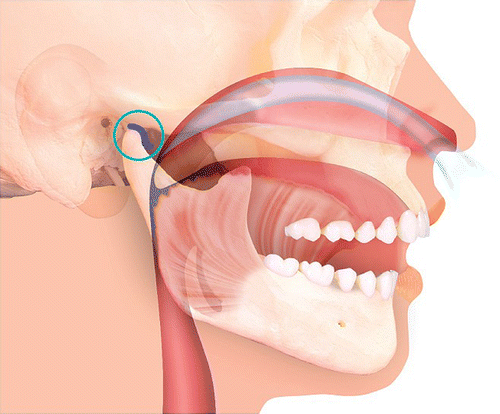 Figure 1 The site of airway narrowing can be seen behind the tongue and soft palate.