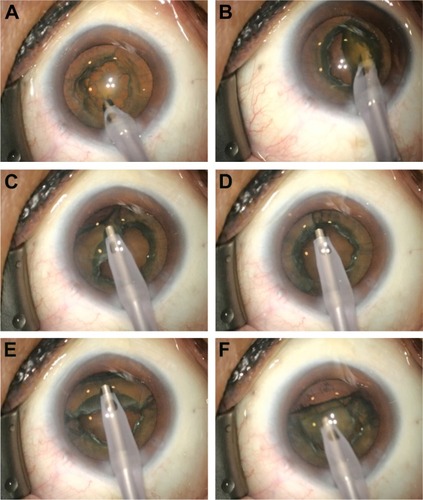 Figure 1 (A) After removal of the cortex and epinucleus, the rim of the endonucleus is removed piecewise while the lens is rotated by a phaco tip. (B) The endonucleus is dislocated by the phaco tip. (C) A peripheral groove is created from the lens equator to the 6 o’clock position. (D) After lens rotation through 180° using the phaco tip, a new groove is created. (E) After 90° lens rotation using the phaco tip, the cortex and epinucleus are emulsified in the 6 o’clock direction. Next, the lens is folded along the grooves and separated from the posterior capsule. (F) The lens remnant is flipped and emulsified.