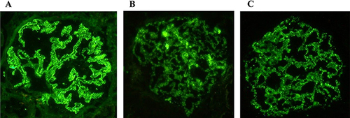 Figure 2 Positive examples of IgG (A), IgG1 (B), IgG4 (C) under immunofluorescence (original magnification×400) are present along the glomerular capillary wall in MN patients.
