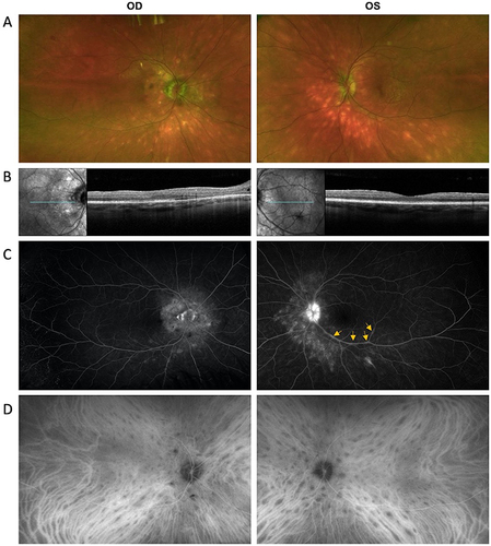 Figure 1 Multimodal imaging of patient at initial presentation. (A) Fundus photographs show optic disc edema and ovoid hypopigmented chorioretinal lesions around the optic disc and in the periphery in both eyes (OU). The right eye (OD) also showed peripapillary atrophy, macular retinal pigmental epithelium changes, and small retinal heme superotemporally. (B) SD-OCT showed optic disc elevation with peripapillary intraretinal fluid and mild epiretinal membrane (ERM) OD > OS. (C) Wide-angle fluorescein angiography showed hazy media, disc leakage around the rim and peripapillary staining OD and diffuse optic disc leakage with mild segmental staining of venules along the inferior temporal arcade OS (arrows). There was hyperfluorescence of several of the lesions in the peripapillary region and along the inferior temporal arcade without any sign of leakage OU. (D) Wide-angle indocyanine green angiography showed multiple hypocyanescent spots in the posterior pole and midperiphery in the intermediate phase of indocyanine green angiography.