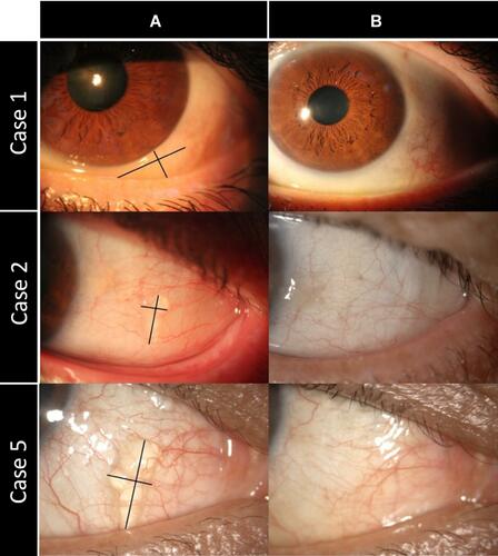 Figure 2 Patient slit lamp images (A) before (B) six months after treatment.