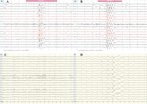 Figure 3 EEG results of epilepsy patients before and following ASM treatment. (A and B) Before treatment with ASM, the patient’s VEEG revealed frequently synchronized paroxysm of short-range spike and wave complex, polyspike wave complex in both frontal regions, apparent in the right frontal area, which could spread to the adjacent leads. (C and D) After treatment with ASM, the patient’s AEEG revealed spike and wave complex in the right middle and posterior temporal areas during sleep.