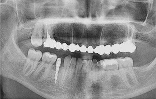 Figure 11 Panoramic radiograph after treatment completion.