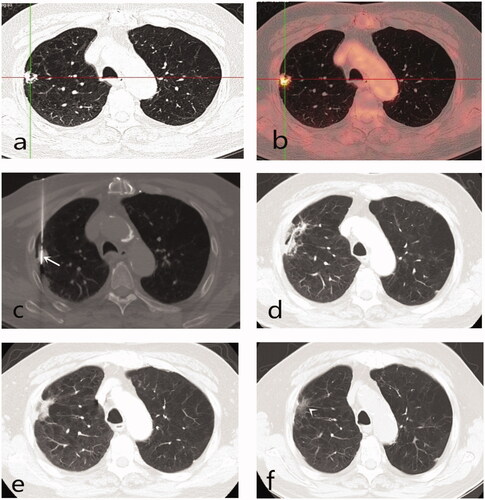 Figure 2. Eighty-year-old male with 1.4 × 1.4 cm right upper lobe T1N0M0 non-small cell lung cancer (adenocarcinoma) comorbid severe emphysema completely ablated by microwave ablation (MWA). (a, b) Tumor lesion on positron emission tomography-computed tomography prior to MWA (standardized uptake value 10.3); (c) MWA, the antenna punctured the central position of the lesion through emphysematous zones (arrow); (d–f) Axial CT scans between 1 month and 18 month post-ablation showed gradual shrinkage of the ablated lesion; and became a fiber scar 18 months after ablation (arrowhead).