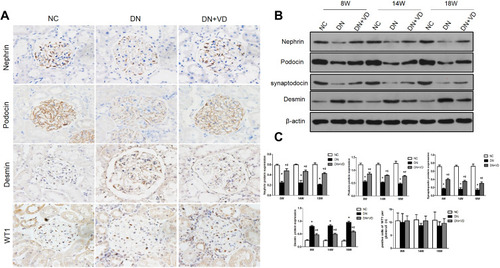 Figure 5 Calcitriol treatment preserved slit diaphragm proteins and reduced podocytes injury in diabetic nephropathy. SD male rats were intraperitoneally injected with 60 mg/kg streptozotocin. After 3 days, the rats with STZ treatment were garaged with 0.1μg/kg/d calcitriol or vehicle solution daily for consecutive 18 weeks. Kidney tissues were collected for histology. (A) Representative images of immunohistochemical staining for nephrin, podocin, desmin and WT1 (Wilms’ tumor 1) in renal cortex at 18th week (400×). (B) Immunoblot analysis of nephrin, podocin and desmin at 8th, 14th, 18th week in three groups. β-actin was used as the internal loading control. (C) Densitometry analysis of nephrin, podocin desmin and WT1. Data are expressed as means ± SD (n=6). Significance: *P<0.05 vs NC group, # P<0.05 vs DN group at the same time point, respectively.