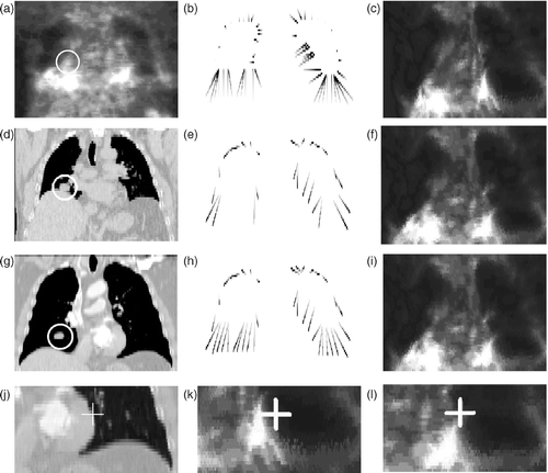 Figure 13. Original PET (a) and CT (d and g) images in a pathological case (patient B: the tumor is surrounded by a white circle). The correspondences between the selected points in the PET image and the end-inspiration CT image (g) are shown in (b) for the direct method, in (e) for the method with the breathing model and a non-uniform landmark points detection, and in (h) for the method with the breathing model and a pseudo-uniform landmark points selection (corresponding points are linked). Registered PET is shown in (c) for the direct method, in (f) for the method with the breathing model with a non-uniform landmark point distribution, and in (i) for the method with the breathing model and landmark points pseudo-uniformly distributed. In panels (e) and (h) it can be observed that landmark points are better distributed with a uniform selection. The fourth row shows registration details in the region between the lungs in a pathological case: (j) is the end-inspiration CT; (k) is the PET registered without the breathing model; and (l) is the PET registered with the breathing model. The white crosses correspond to the same coordinates. The method using the breathing model avoids unrealistic deformations in this region. [Color version available online.]