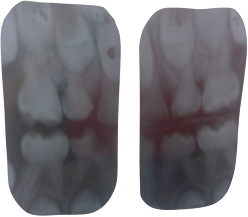 Figure 1 Vertical bitewing radiographs of patient with OIDI in the primary dentition, showing characteristic features of pulpal obliteration and bulbous crowns.