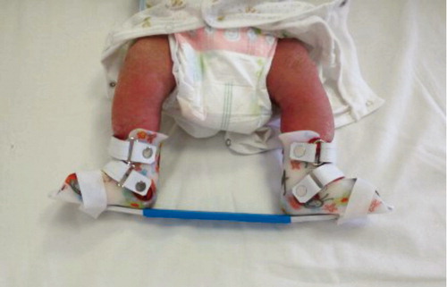 Figure 2. Foot-abduction brace was applied in our clinics. The brace consists of a bar with the shoes attached at 60–70° of abduction on the affected side and 30–40° on the normal side.