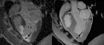 Figure 1. MR-MSCs lesions (arrow) in CE-MRI (left) and FGRE images (right) in the long-axis plane demonstrating successful transplantation in MI.