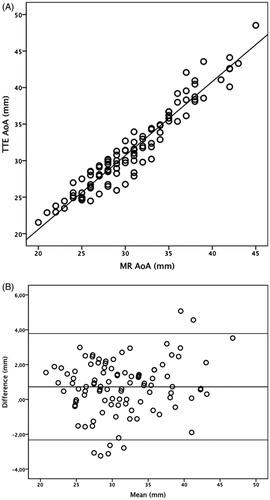 Figure 1. Linear regression, r2 = 0.93 (a) and Bland–Altman plot (b) for diameters of the ascending aorta measured by TTE and MRI. The individual mean aortic diameters measured with TTE and MRI are shown on the x-axis and the deviation from the mean the y-axis. The middle horizontal line shows the mean difference between TTE and MRI (0.72 mm), i.e. TTE systematically reports slightly higher values than MRI.