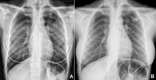 Figure 2 Chest radiography images (A) before and (B) after nine months of isoniazid treatment for the patient who progressed to active disease following the latent tuberculosis infection treatment.
