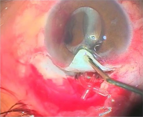 Figure 7 Alahmady ring after cutting the silicon tube near penetration.