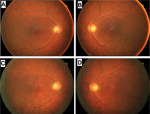 Figure 2 Fundus photographs of a patient diagnosed with carcinoma-associated retinopathy who developed choroidal atrophy during a 2-year follow-up period. Fundus photographs of the right (A) and left (B) eyes taken at the initial examination in June 2010. Fundus photographs of the right (C) and left (D) eyes taken in October 2012.
