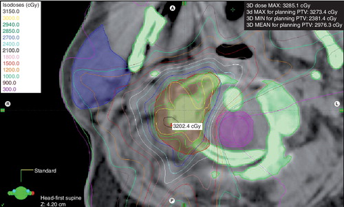 Figure 1. C1 vertebral metastasis from breast cancer treated with stereotactic body radiation therapy.The prescribed dose was 30 Gy (6 Gy × 5) at the isocenter; the maximum spinal cord dose was limited to 9 Gy in five fractions; with a shift of 2 mm (as represented by the 2-mm expansion of the spinal cord contour), the maximum point dose to the spinal cord is increased to 18 Gy in five fractions.A: Anterior; L: Left; P: Posterior; PTV: Planning treatment volume; R: Right.