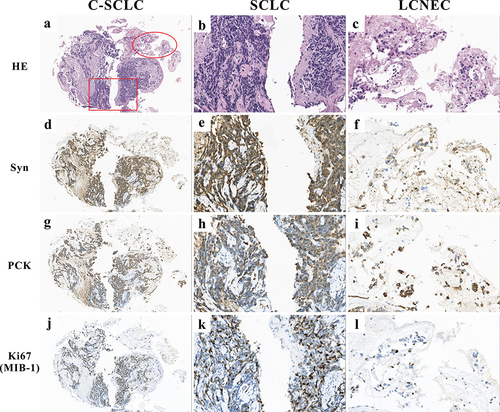 Figure 2 Histological analysis of the transbronchial lung biopsy revealed two different tumor components. (a) Hematoxylin and eosin (H&E) staining showing C-SCLC (combined SCLC and LCNEC, 100×). (b) SCLC is characterized by the presence of diffuse sheets of small round-to-fusiform cells, with scant cytoplasm, and inconspicuous or no nucleoli with finely granular nuclear chromatin. Meanwhile, nuclear chromatin smearing, also termed crushed artifact, is common in SCLC (400×). (c) LCNEC is characterized by large cells, frequent presence of nucleoli and abundant cytoplasm (400×). (d–f) Both the SCLC and LCNEC components were positive for synaptophysin (Syn, 100×, 400×). (g) Different modes of PCK expression in C-SCLC (100×). (h) The so-called dot-like staining pattern of PCK in SCLC (400×). (i) The LCNEC component was diffusely positive for PCK in the cytoplasm (400×). (j–l) Different Ki67 levels were found in both tumor components (100×, 400×).