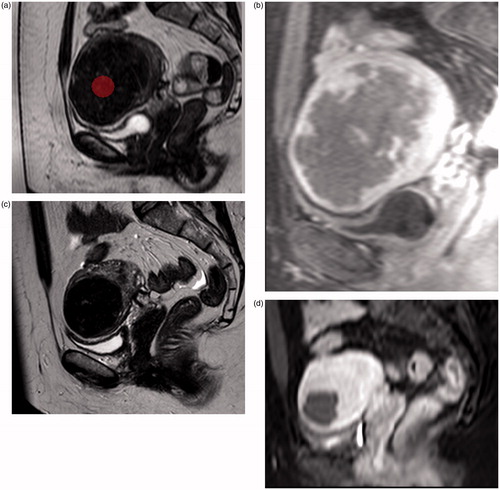 Figure 1. About 177 cc uterine fibroid with low mean sum of entropy (1.71) corresponding to an ablation efficiency of 3.61. The “in-MRI room” duration was 103 min: (a) sagittal T2-weighted image with ROI on MAZDA; (b) sagittal T1-weighted contrasted enhanced imaging showing a non-perfused volume of 124 cc (70%) at the end of the procedure; (c) sagittal T2-weighted image 1 year after MRgFUS; (d) sagittal T1-weighted contrasted enhanced imaging 1 year after MRgFUS showing a significant volume decrease.