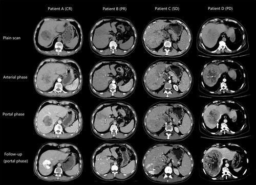Figure 2 Computed tomography (CT) images of typical cases in TR and TN groups. CT images of patient A (CR, TR group) before TACE show a spherical mass located in the right lobe, with slight hyperenhancement on the arterial phase and an intact tumor capsule visible on the portal venous phase. Post-procedure CT image shows diffuse deposit of iodine oil and no enhancement of the lesion. CT images of patient B (PR, TR group) before TACE show an infiltrated lesion with visible tumor vessels on the arterial phase, and type I PVTT (arrow) on portal venous phase. Post-procedure CT image shows dominant shrinkage of the lesion with slight enhancement. CT images of patient C (SD, TN group) before TACE show ill-defined infiltrative lesion with type IV PVTT involving the main portal vein (arrow) and the superior mesenteric vein (not shown) on the portal venous phase. Post-procedure CT image shows no obvious shrinkage or progression of the lesion with some blood supply. CT images of patient D (PD, TN group) before TACE show a large mass involving multiple segments of liver, with abundant tumor vessels visible on the arterial phase, hepatic vein invasion (arrow) and type III PVTT involving the main portal vein (not shown). Dominant enlargement of the lesion can be seen in the post-procedure CT image.