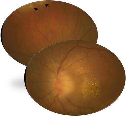 Figure 4 Fundus photograph of the left eye of a patient with rickettsial disease shows optic disc edema and a macular star. Note the presence of foci of inner retinitis in the superior periphery (arrows).