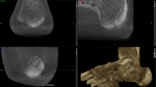 Figure 4 Follow-up weight-bearing CT (WBCT) six weeks after the first combined bone stimulation treatment, which was two weeks after the last session with substantial improvement of the delayed union situation at that early point in time.