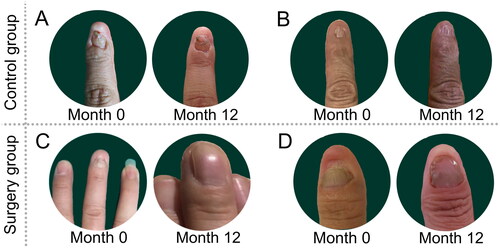 Figure 5. Comparison of outcomes at baseline and 12 months post-intervention between the control group and surgical group (fingers): (A, B) control group: for two patients, who did not undergo any specific treatment, no notable alteration in the nail bed is observed after 12 months. (C, D) Surgery group: the figure demonstrates the significant changes in the newly formed nail plate following surgical intervention.