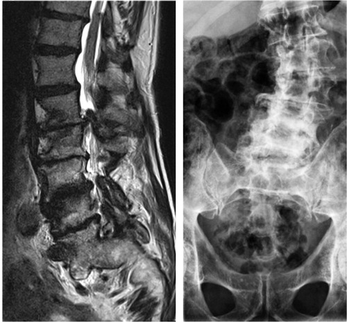 Figure 4. Sagittal MR image (left) and a radiograph (right) showing severely degenerated lumbar spine. Observe severe disc degenerations, facet joint hypertrophy with lateral recess stenosis and degenerative scoliosis in addition to the ankylotic and spondylolisthetic L5–S1 segment.
