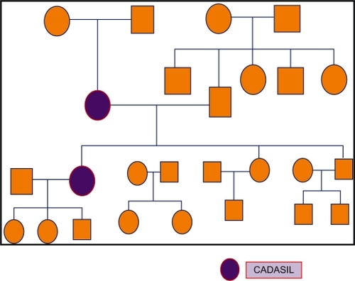 Figure 6 Pedigree of the family with cerebal autosomal dominant arteriopathy with subcortical infarcts and leuoencephalopathy (CADASIL).