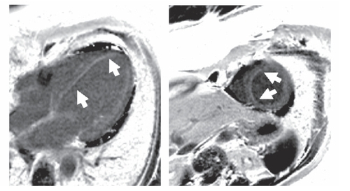 Figure 2A Magnetic resonance imaging of the left ventricle. Phase sensitive T1-weighted contrast based late enhancement sequence (PSIR). A subendocardial bandlinke hyperintensity in the interventricular septum was found in the four chamber view and short axis orientation (arrow). A small pericardial effusion was present.