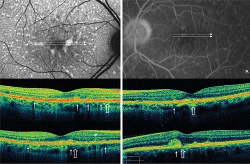 Figure 5 A) Case 5 fundus autofluorescence and high definition spectral domain optical coherence tomography (HD-OCT). Fundus autofluorescent frame of the right eye (20/25 best corrected visual acuity) shows mottled autofluorescence in the macular area and several diffuse retinal flecks. HD-OCT scans show disruption of either the layer between the retinal pigment epithelium (RPE) and the outer segment (OS) of the photoreceptors (PR), either the layer corresponding to the interface of inner segment (IS) and OS of PR in the foveal region (asterisk), and a focal loss of the PR layer in the parafoveal region (open arrows). Small, large and very large hyperreflective lesions presented as dome-shaped deposits located within the RPE and at the level of the outer segments of PR (thin arrows), and small linear deposits located at the level of the outer nuclear layer and clearly separated from the RPE layer (arrowhead), are visualized by HD-OCT scans. B) Case 1 fluorescein angiography and HD-OCT. Fluorescein angiography frame of the left eye (20/50 best corrected visual acuity) shows mottled fluorescence in the macular area and several diffuse retinal flecks. HD-OCT scans show a focal loss of the photoreceptor layer in the foveal region (open arrows), and very large hyperreflective lesions presented as dome-shaped deposits located within the retinal pigment epithelium (thin arrows).