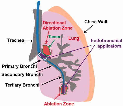 Figure 1. Concept diagram of proposed treatment strategy for ablation of lung tumors adjacent to major and sub-segmental tertiary bronchi using endobronchial ultrasound applicators: larger diameter applicator configurations composed of planar or sectored tubular transducer segments for treatment of tumors at large airways, and smaller diameter applicators with tubular sources for targeting tumors adjacent to deep lung sites.